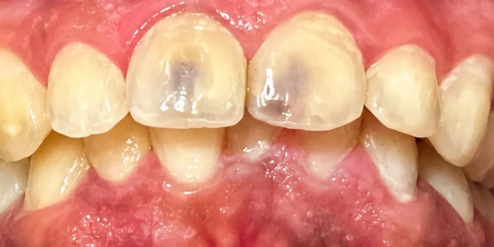 Before treatment: two darkened, discoloured front teeth