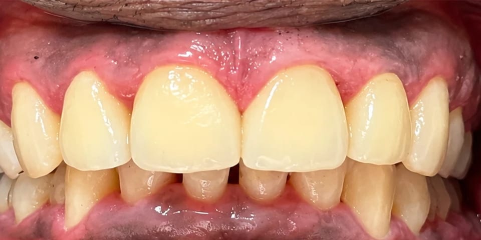 After treatment: fuller, more even front teeth