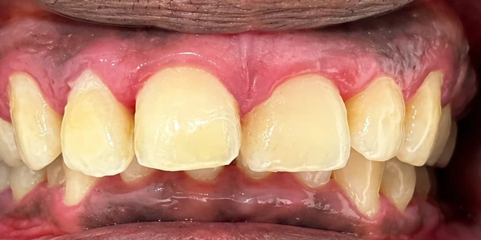 Before treatment: worn, uneven front teeth