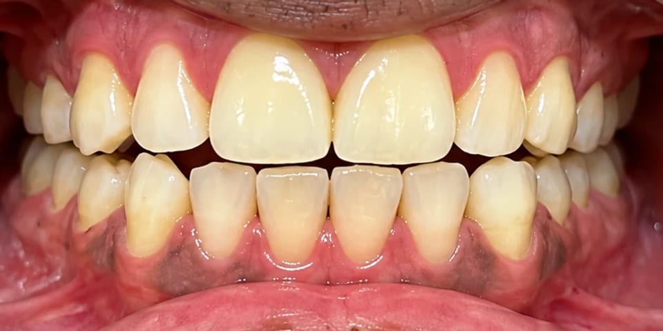 After treatment: the gaps closed, top and bottom
