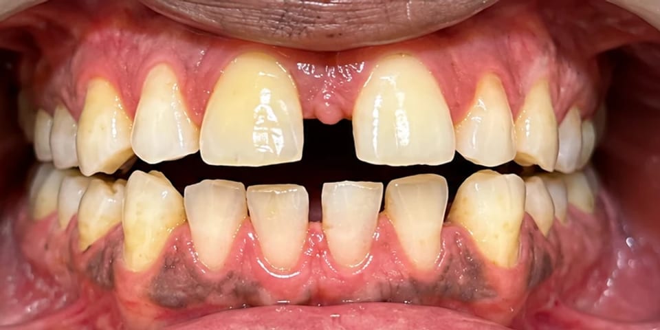 Before treatment: a wide gap between the front teeth
