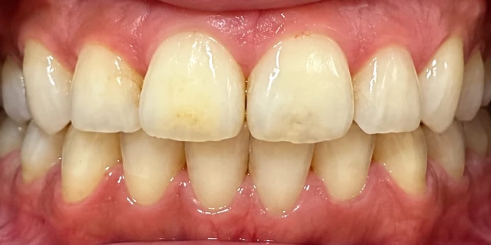 Before treatment: a duller, uneven tooth shade