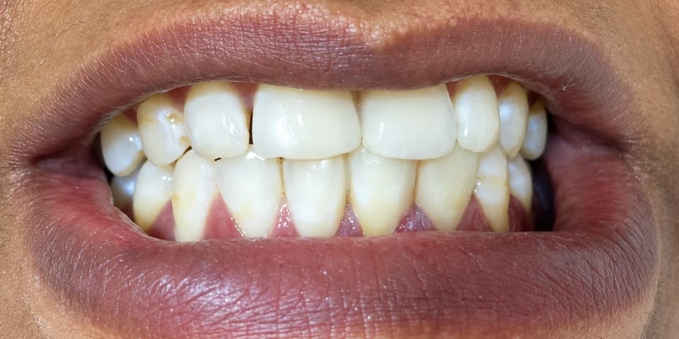 After treatment: the spacing closed