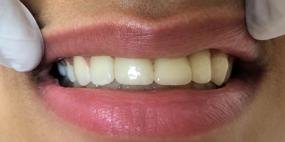 After treatment: a full row of upper front teeth