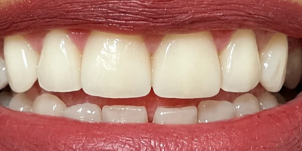 After treatment: the teeth rebuilt to match the rest of the smile