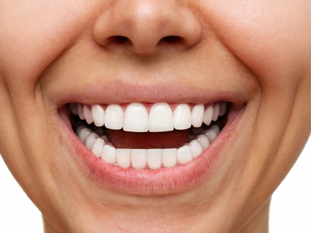 Smile after porcelain veneer treatment: even, brighter teeth