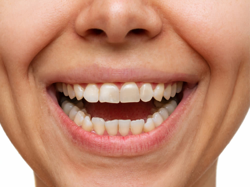 Smile before treatment: uneven, discoloured teeth
