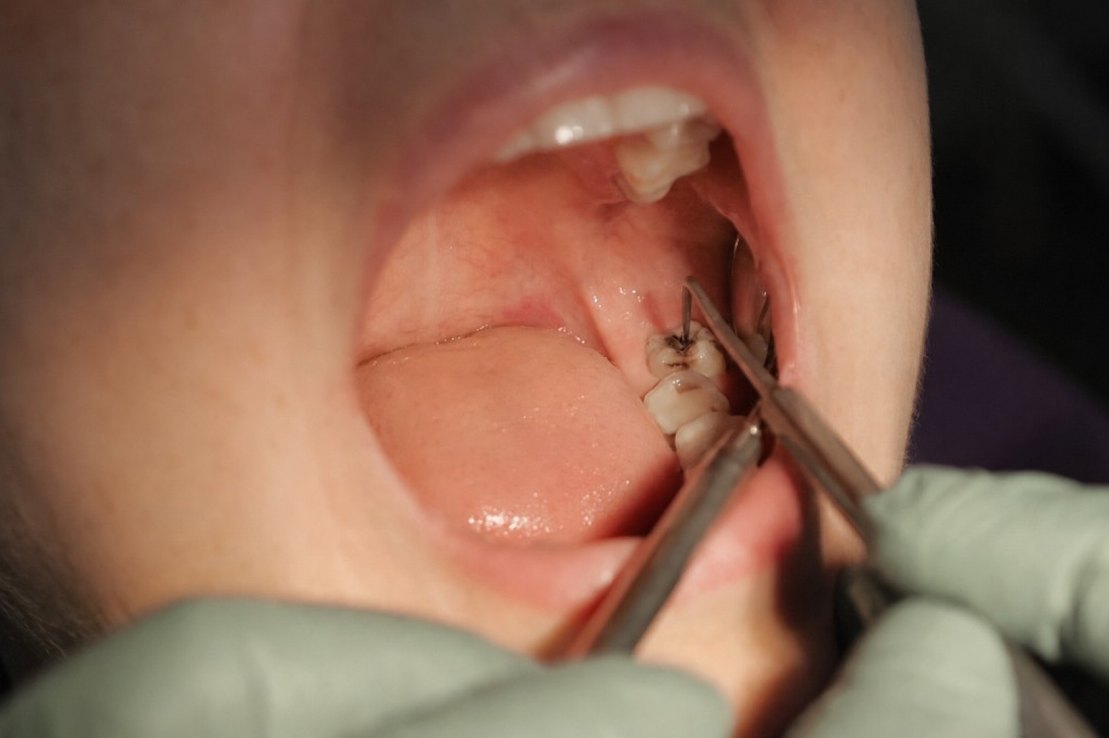 Examining decay before root canal treatment