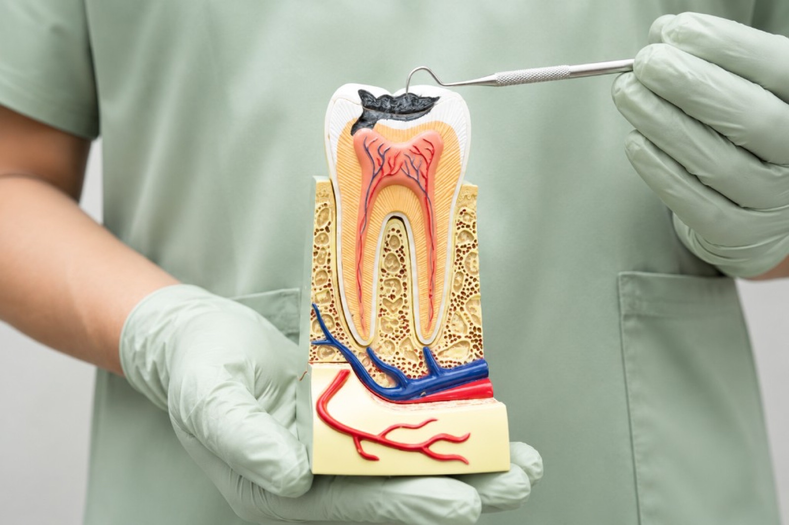 Tooth model showing pulp, nerves and deep decay